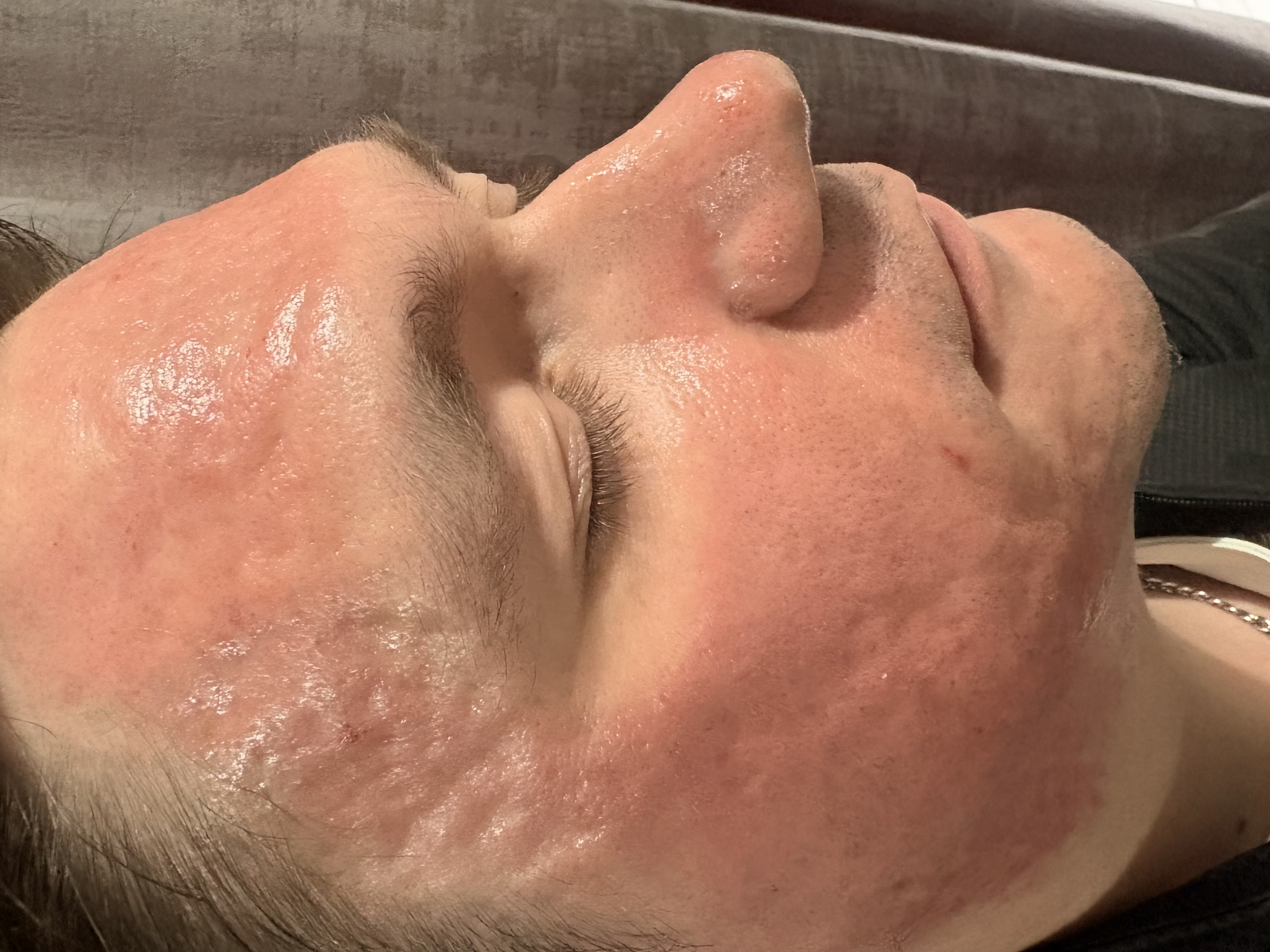After aesthetic treatment at NEWBY Skin Clinic in Ashford