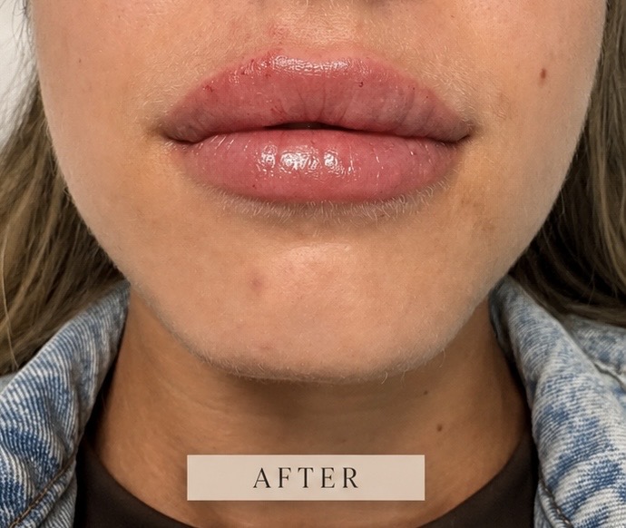 After facial aesthetic treatment at NEWBY Skin Clinic in Ashford