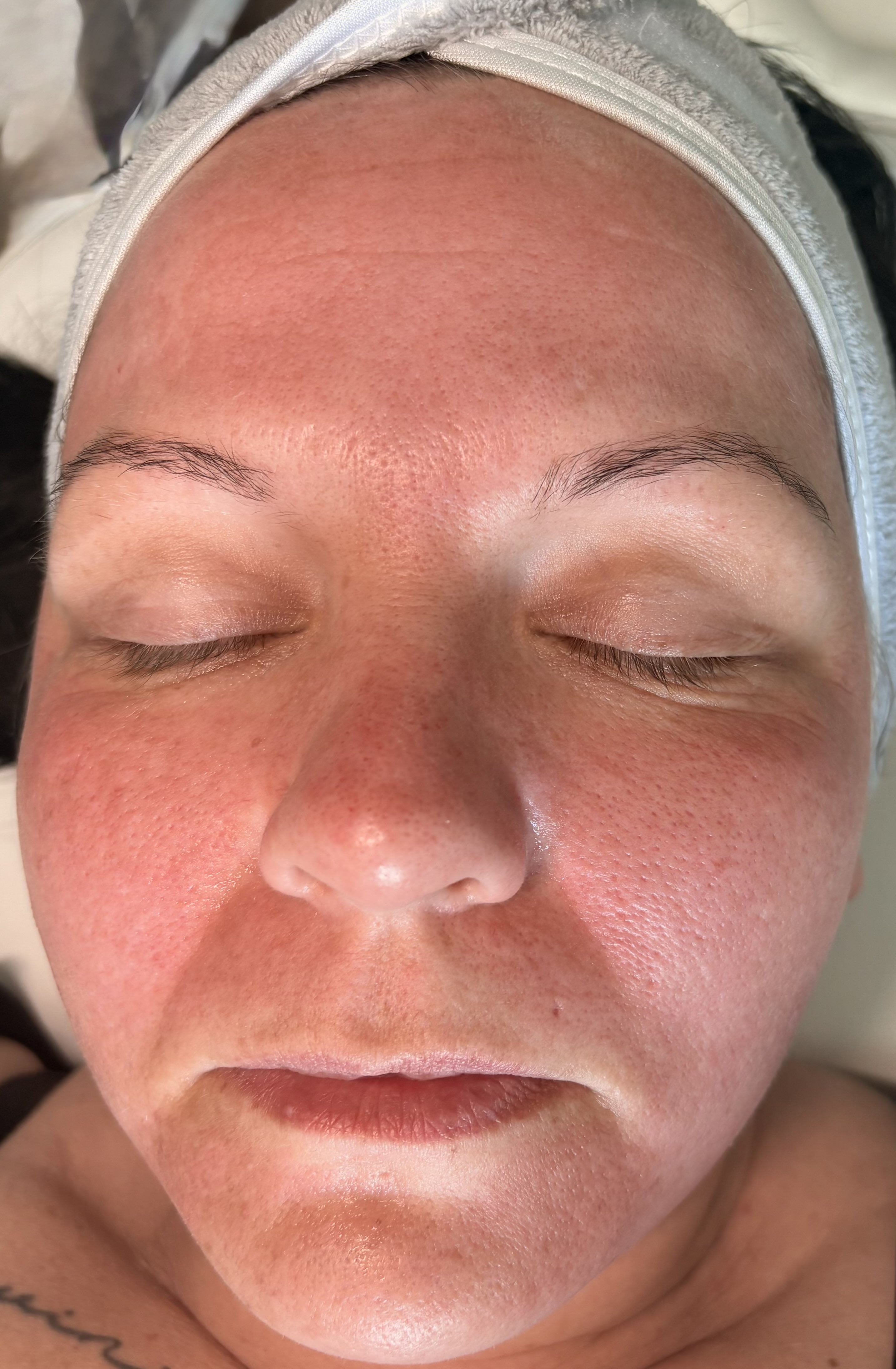 After skin treatment at NEWBY Skin Clinic in Ashford