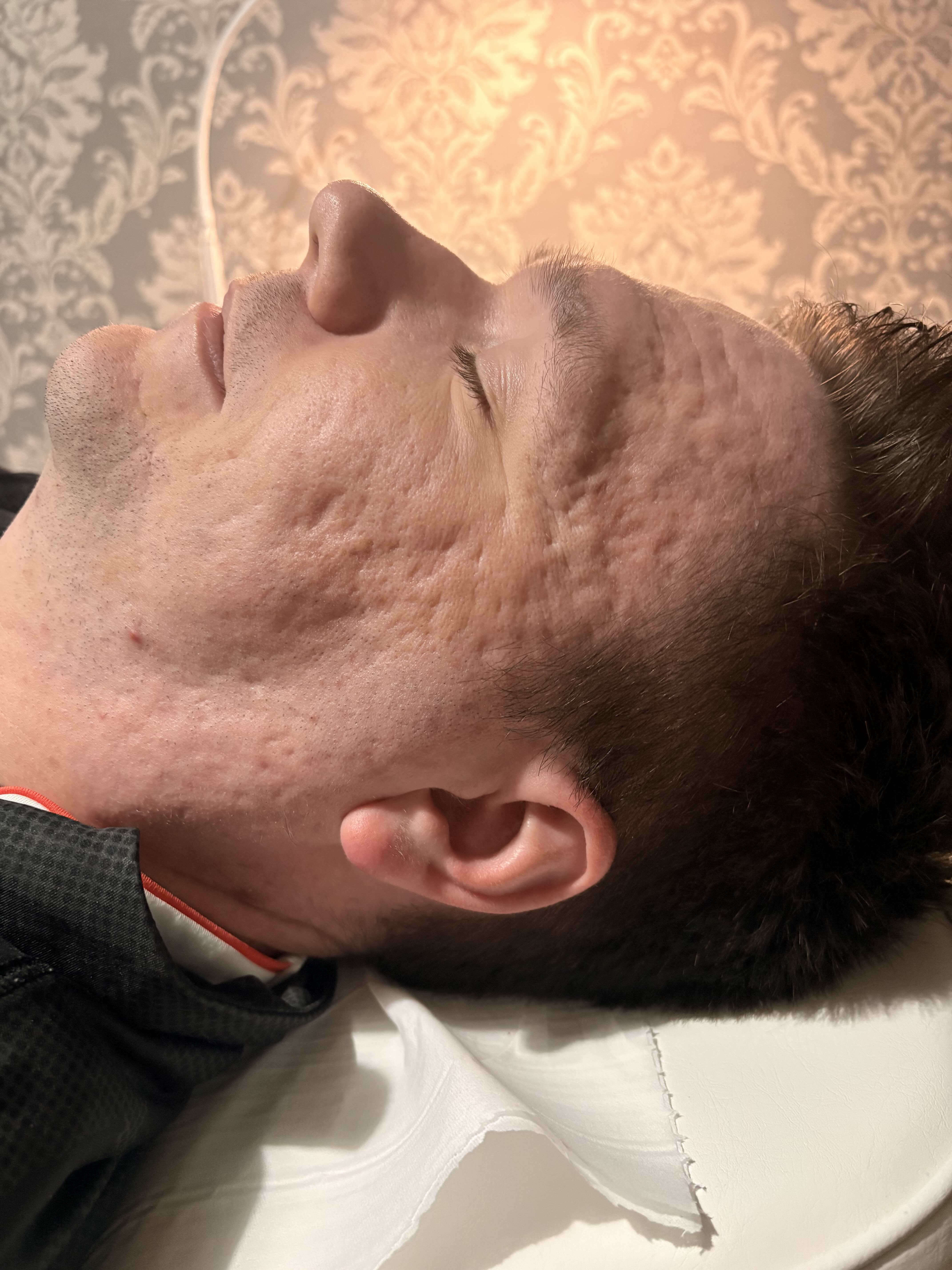 Before aesthetic treatment at NEWBY Skin Clinic in Ashford