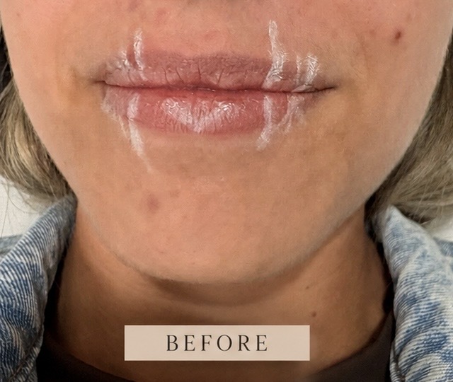 Before facial aesthetic treatment at NEWBY Skin Clinic in Ashford