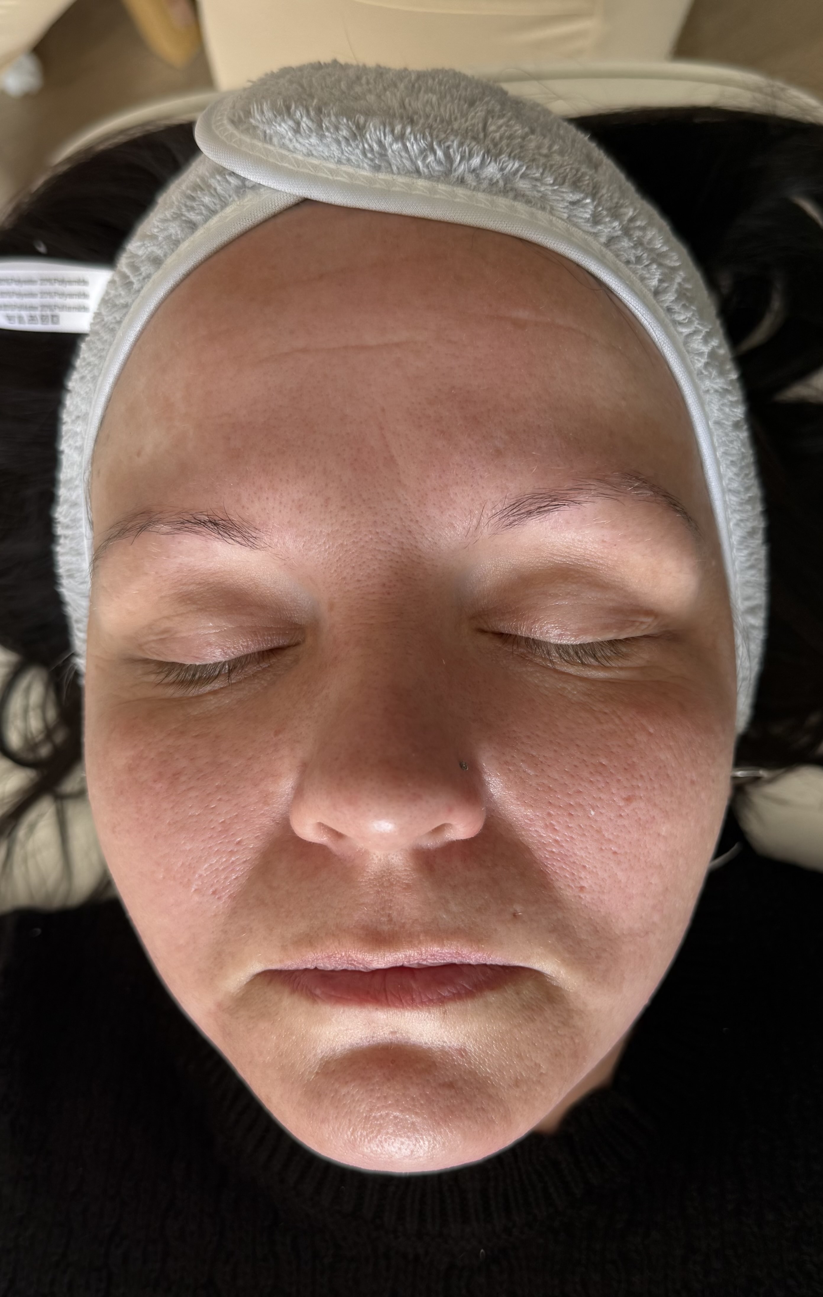 Before skin treatment at NEWBY Skin Clinic in Ashford